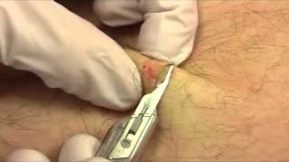 Shave Biopsy [upl. by Grange]