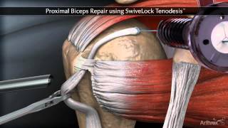 Proximal Biceps Repair using SwiveLock Tenodesis [upl. by Riley]