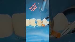 Composite BONDING teeth [upl. by Tod101]