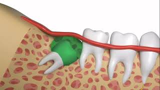 How To Safely and Quickly Have a Wisdom Tooth Extraction [upl. by Dnalwor]