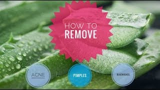 How to remove Acne Pimples and Blackheads in just 3 Days  With the help of Aloe Vera [upl. by Bidget675]