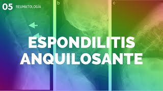 ESPONDILITIS ANQUILOSANTE  ENARM [upl. by Duer]