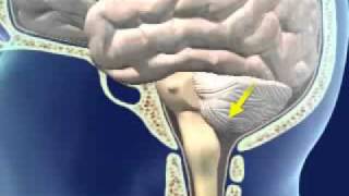 Brainstem Herniation [upl. by Tonry]