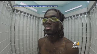 Doctor Says Vitiligo Can Be Treated [upl. by Selrac]