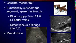 Sonography of the Liver [upl. by Neri786]