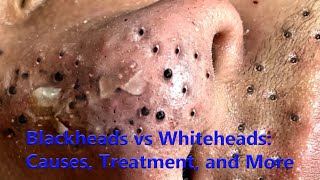 Blackheads vs Whiteheads Causes Treatment and More [upl. by Clover]