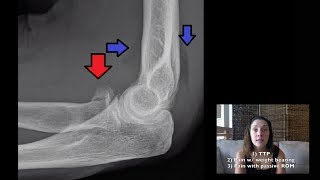 Fracture Clinical Pearls [upl. by Assetan473]