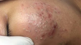 How To Remove Blackheads And Whiteheads On Face Easy 61 ✦ Dr Laelia ✦ [upl. by Cavill533]