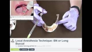 Long Buccal Dental Anesthesia Technique [upl. by Erda965]