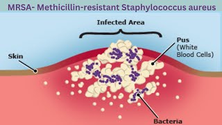 What is MRSA Methicillin Resistant Staphylococcus Aureus [upl. by Cooperstein]