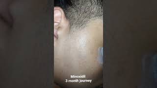 minoxidil 5 beard growth 3 month journey mintop minoxidil [upl. by Nesta]