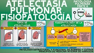 ATELECTASIA PULMONAR FISIOPATOLOGÍA  GuiaMed [upl. by Ocsicnarf]