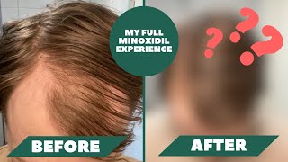 I Have Been Using Minoxidil For 1 Year And Here Are The Results  My Full Minoxidil Experience [upl. by Atirys246]