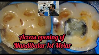 Access opening of Mandibular1st Molar step by step demonstration Rct for beginners dentallectures [upl. by Bentlee]