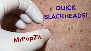 Quick and easy blackhead extractions Imbedded plugs removed with ease [upl. by Nylatsirk319]