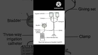 bladder irrigation [upl. by Deni]