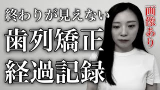 【歯列矯正】あれから2年。終わりが見えない。歯列矯正経過記録画像あり アンフィットamp骨隆起amp圧下 [upl. by Imoyn176]