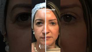 Harmonização periocular associação de lifting de supercilios blefaroplastia superior e inferior [upl. by Goody279]