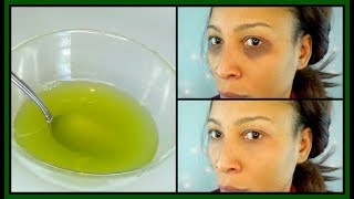 HOW TO GET RID OF DARK CIRCLES UNDER THE EYES EYE BAGS PUFFY EYES  ITCHING EYES Khichi Beauty [upl. by Eido]