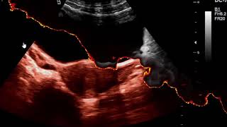 Ovarian Dominant Follicle on ultrasound [upl. by Pauwles987]