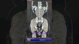 Above CECT findings reveals grade I prostatomegaly with left simple cortical renal cyst as describ [upl. by Meil]