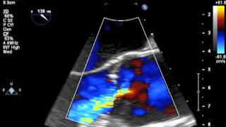 Transesophageal Echocardiography Performed in the LongAxis View at the Midesophageal Level [upl. by Harlin84]