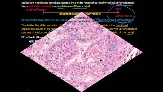 113P How to tell a benign and malignant tumor apart Differentiation and Anaplasia [upl. by Arihk]