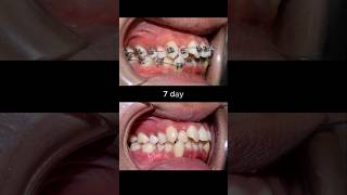 Evolution Of Braces 30 months braces orthodontist dentist dental [upl. by Yecam]