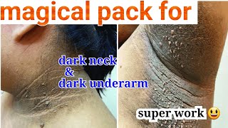 neck whitening tips dark neck DIY remove sun tan easily at home dark neck underarms how to treat [upl. by Ker]