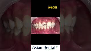 Invisible Braces Treatment in Vijayawada amp Hyderabad  Asian Dental  invisiblebraces happypatient [upl. by Ferino463]