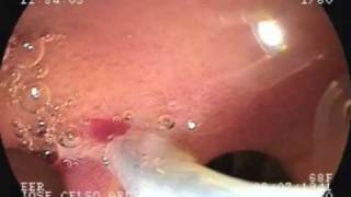 Duodenal carcinoid tumor  endoscopic resection after EUS [upl. by Zetroc449]