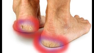 How to Repair Cracked And Dried Feet At Home Fast  Dry Cracked Heels Treatment [upl. by Layor]