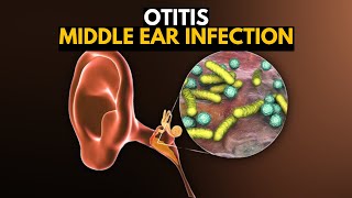 Middle Ear Infection Otitis Media Causes SIgns and Symptoms Diagnosis and Treatment [upl. by Ravahs]