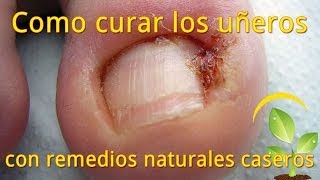 Como curar los uñeros con remedios naturales o uñas encarnadas  10 formas [upl. by Geirk]