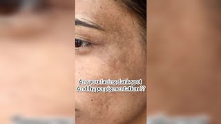 best serum for dark spot and hyperpigmentation [upl. by Eatnoid957]