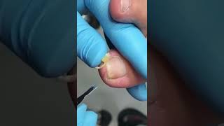 Ingrown toenail removal with Pedicure Knife Cut it easily Ep524 [upl. by Lee169]