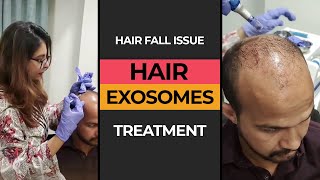 Exosomes Treatment for Hair Fall Issue  HASH CLINICS [upl. by Vicki366]