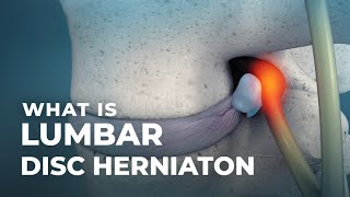 What is Lumbar Disc Herniation  Atlantic Spine Center [upl. by Fulmis]