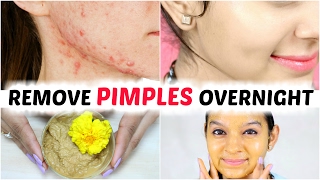 How To Remove Pimples Overnight  Acne Treatment  Anaysa [upl. by Trebmer172]