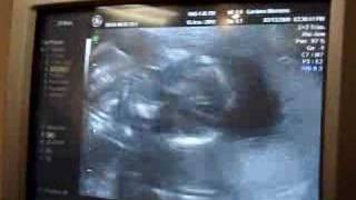 Is It A Boy Or Girl 19 week Ultrasound [upl. by Layney]