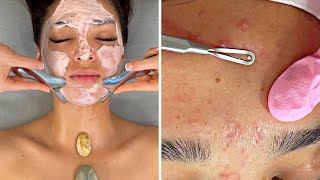 ACNE NO Talking SPAASMR Facial Pimple Popping [upl. by Lada]