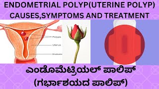 ENDOMETRIAL POLYPUTERUS POLYP CAUSES SYMPTOMS TREATMENT IN KANNADAINFERTILITY ENDOMETRIAL POLYP [upl. by Eaves262]