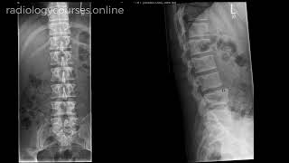 What is limbus vertebra How to describe it What is the clinical significance [upl. by Nwahshar314]