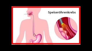 Erkrankungen der Speiseröhre – häufigste Symptome [upl. by Fridlund]