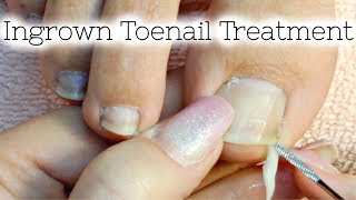 Pedicure Tutorial Ingrown Toenail Treatment At Home How to Recut Nail Groove to Eliminate Pain [upl. by Nate]