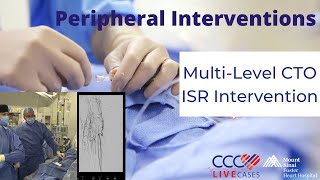 MultiLevel CTO ISR Intervention [upl. by Cherise818]