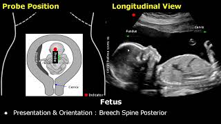 Obstetric Ultrasound Probe Positioning  Pregnant Uterus amp Fetus Transducer Placement USG Scan [upl. by Toogood159]