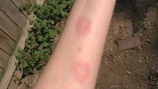 Erythema Nodosum [upl. by Asiled]