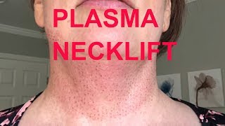 LIVE Neck lift without surgery  My Plasma Fibroblast Necklift 2 [upl. by Sibylle]