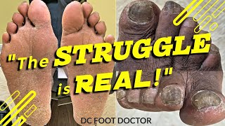 The Struggle is Real Struggling with Foot Care and Underlying Health Issues Toenails and Calluses [upl. by Flavian]